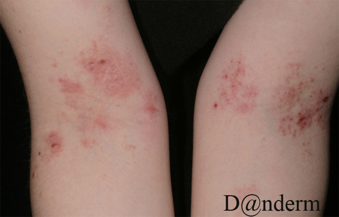 Atopic dermatitis - Wikipedia