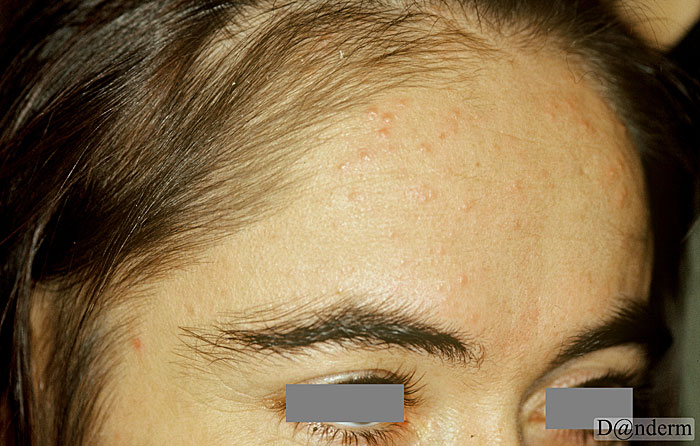 4-7-2 Hypertrichosis following treatment with minoxidil
