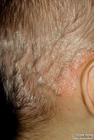 psoriasis in the scalp