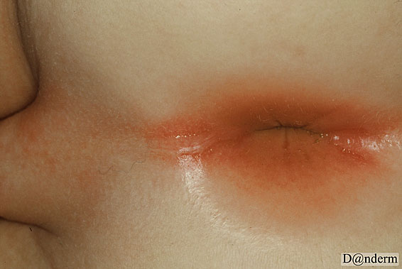 images of psoriasis #10