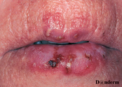 Discoid Lupus Erythematosus - When Lupus Only Affects the Skin