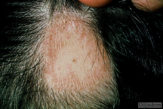 6 15 1 Discoid Lupus Erythematosus Of The Scalp