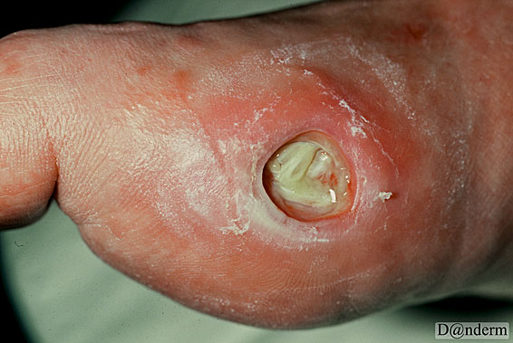 diabetic ulcers pictures