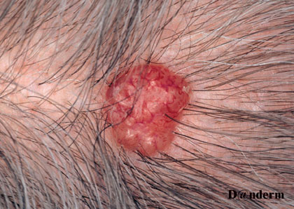 Basal Cell Carcinoma On Scalp Images