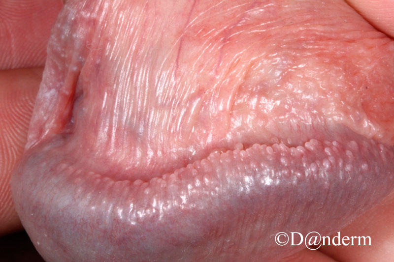 Pearly papules pink Pearly Penile