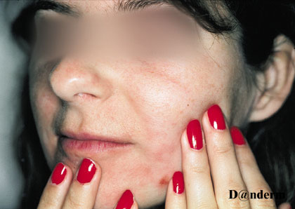 Allergic contact dermatitis - Stock Image - C056/2487 - Science Photo  Library