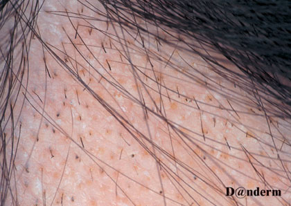 4-19 Alopecia areata with exclamation mark hairs