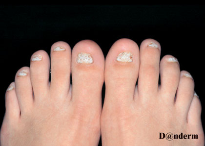 Current Concepts In Treating Psoriatic Nails