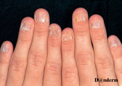 Diagnosis and Management of Nail Disorders in Children