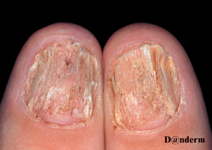 Single injection technique for the management of both nail-matrix and nail-bed  lesions of inflammatory nail disorders - Indian Journal of Dermatology,  Venereology and Leprology