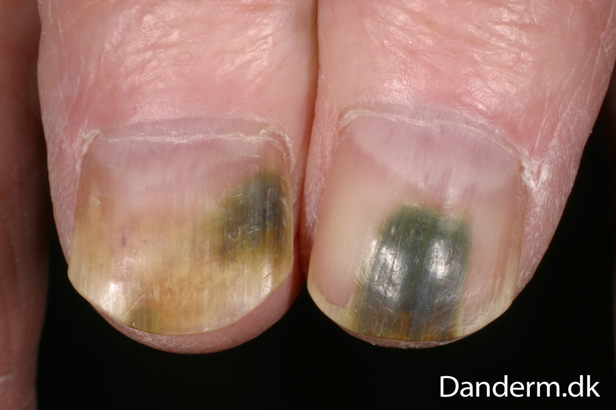 green nails-pseudomonas aeruginosa - Pictures