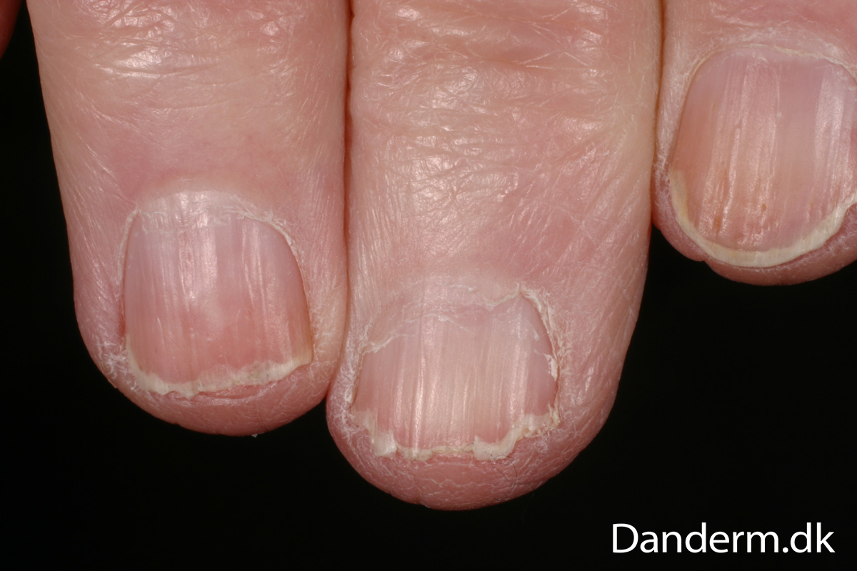 Purpuric nail striae as the initial manifestation in multisystem Langerhans  cell histiocytosis - Prayogo - 2020 - Pediatric Dermatology - Wiley Online  Library