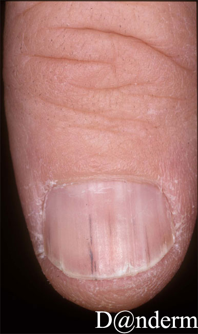 Do you have any experience with Candida pararugosa causing fingernail  onychomycosis? | ResearchGate